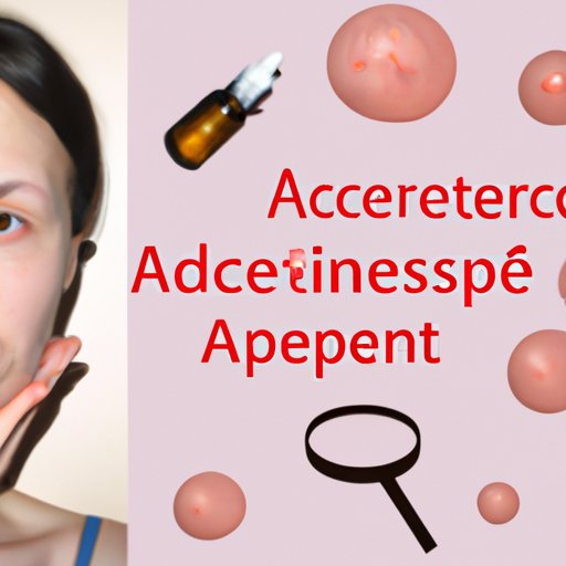 How to Get Rid of Acne Scars OvertheCounter Treatments, Natural