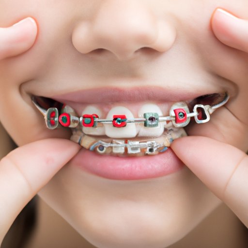 Captivating What Age Do You Have To Get Braces Capture Illustration Captivating What Age Do You Have To Get Braces Capture Illustration